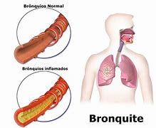 Image result for bronqu�tico