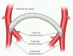 Image result for Carotid Artery Bypass