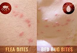 Image result for Flea Bed Bug Bite