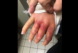 Image result for Flesh-Eating Bacteria On Hand