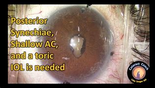 Image result for Posterior Synechiae Surgery