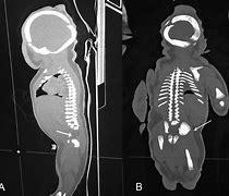 Image result for X-ray of Sirenomelia