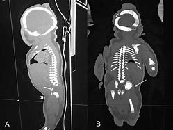 Image result for Sirenomelia Syndrome