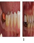 Image result for How to Fix Broken Teeth