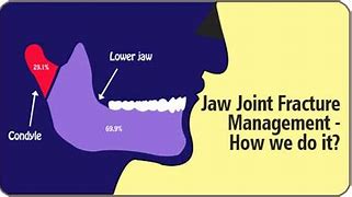 Image result for Narrow Lower Jaw