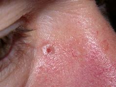 Image result for White Basal Cell Carcinoma