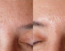 Image result for Skin Build Up On Face