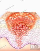 Image result for Genital Wart Identification