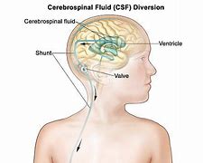 Image result for Hydrocephalus and Cerebral Palsy