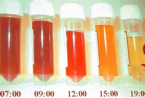 Image result for hemoglobinuria