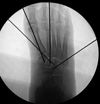 Image result for Lisfranc Fracture Orthobullets