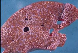 Image result for Honeycomb Pattern Gallbladder Gross
