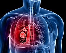 Image result for Subpleural Lung Nodule
