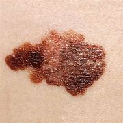 Image result for Skin Cancer Spots