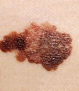 Image result for Raised Skin Cancer Moles