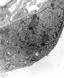 Image result for Pityrosporum Folliculitis