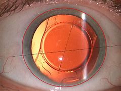 Image result for Toric IOL Alignment