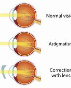 Image result for Contact Lens for Myopia and Astigmatism