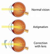 Image result for Astigmatisma