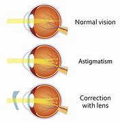 Image result for Hubble Contacts Astigmatism