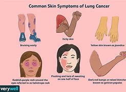 Image result for Lung Adenocarcinoma Skin Lesions
