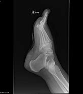 Image result for Homolateral Lisfranc