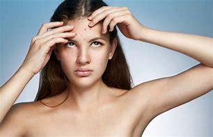 Image result for Acne Scars Amazingly Fast