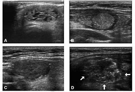 Image result for Spongiform Thyroid Nodule Ultrasound Images