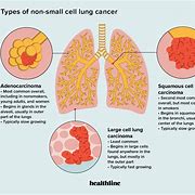 Image result for Lung Cancer Cell Types