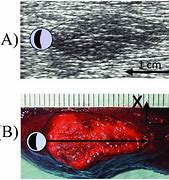 Image result for 9Mm Lesion