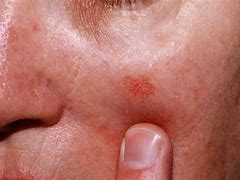 Image result for Actinic Keratosis Lip