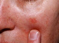 Image result for Actinic Keratosis On Scalp