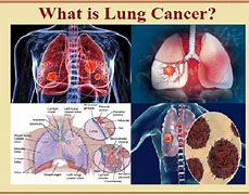 Image result for Heart and Lung Cancer