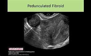Image result for Fibroids On Stems
