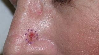 Image result for Bump On Nose Skin Cancer