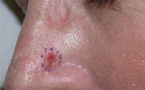 Image result for Basal Cell Carcinoma On Nose Symptoms