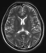 Image result for Demyelinating Disease MRI