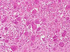 Image result for Soft Tissue Tumor