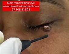 Image result for Under Eye Mole Removal