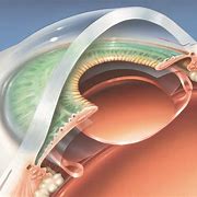 Image result for Cataract Surgery