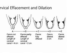 Image result for 3cm dilated cervix