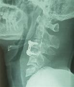 Image result for C3 C4 Spinal Cord Injury