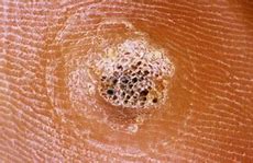 Image result for Flat Warts On Hands Cause