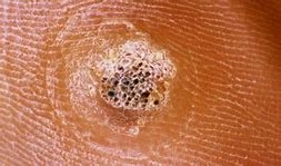 Image result for How to Remove Plantar Warts On Feet