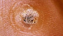 Image result for Small Plantar Warts On Feet