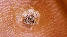 Image result for How to Get Rid of Flat Warts