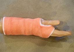Image result for Removable Arm Cast
