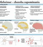 Image result for choroba_neurodegeneracyjna