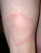 Image result for Circle Rash On Skin