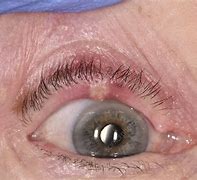 Image result for Cyst On Eyelid